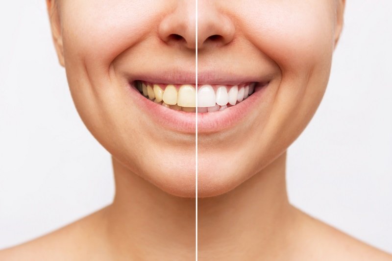 Cropped shot of a young smiling woman before and after teeth whi
